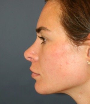 Revision Rhinoplasty 201 - after - front