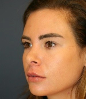 Revision Rhinoplasty 201 - before - oblique
