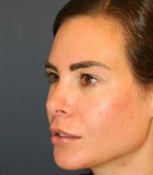 Revision Rhinoplasty 201 - after - oblique