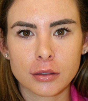 Revision Rhinoplasty 201 - before - side