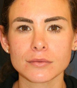 Revision Rhinoplasty 201 - after - side