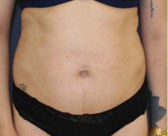 Tummy Tuck 208 - before - front