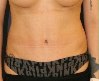 Tummy Tuck 208 - after - front