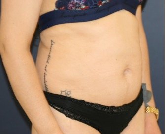 Tummy Tuck 208 - before - oblique