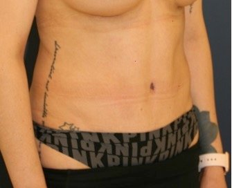 Tummy Tuck 208 - after - oblique