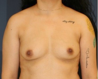 Breast Augmentation 132 - before - front