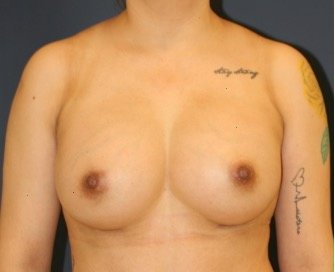 Breast Augmentation 132 - after - front