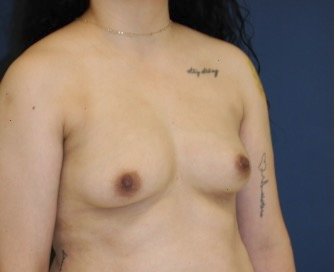 Breast Augmentation 132 - before - oblique