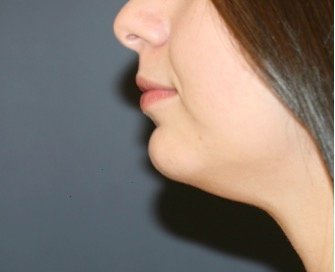Neck Liposuction 202 - before - front