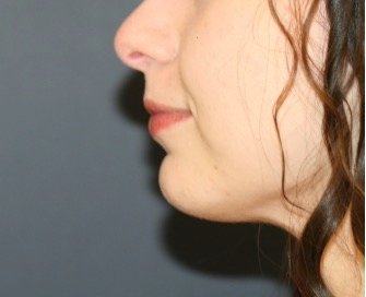 Neck Liposuction 202 - after - front