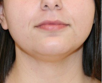 Neck Liposuction 202 - before - side