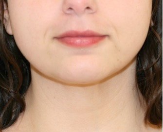 Neck Liposuction 202 - after - side