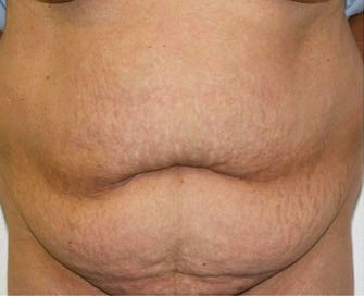 Tummy Tuck Case 6 - before - front