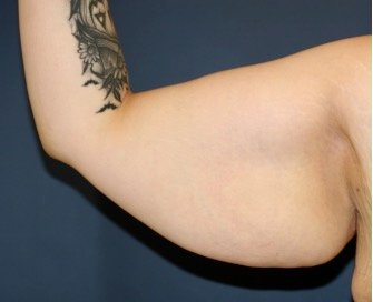 Arm Reduction 203 - before - front