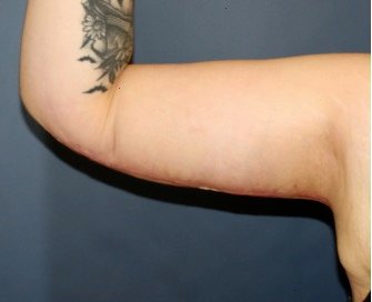 Arm Reduction 203 - after - front