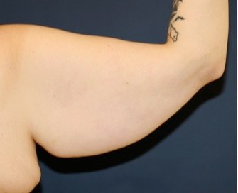 Arm Reduction 203 - before - back