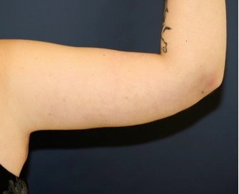 Arm Reduction 203 - after - back