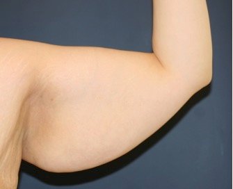 Arm Reduction 204 - before - front