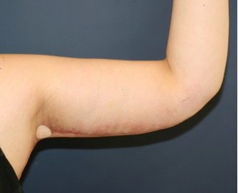 Arm Reduction 204 - after - front