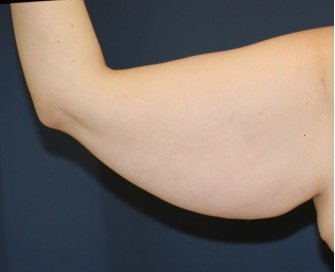 Arm Reduction 204 - before - back