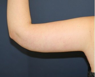 Arm Reduction 204 - after - back