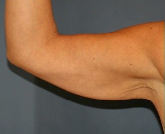 Arm Reduction 205 - before - front