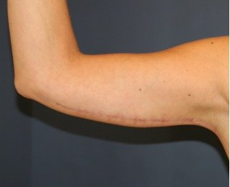 Arm Reduction 205 - after - front