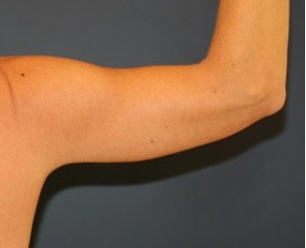 Arm Reduction 205 - after - back