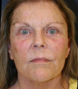 Laser Facial Skin Treatment 201 - before - front