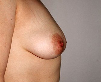 Breast Augmentation Case 32 - before - side