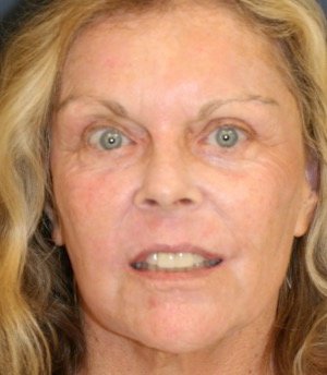 Laser Facial Skin Treatment 201 - after - front