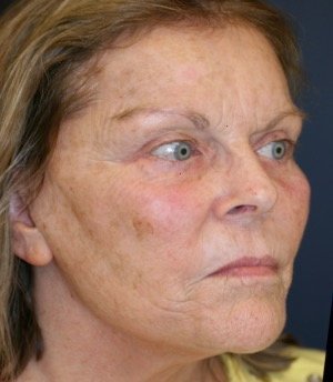 Laser Facial Skin Treatment 201 - before - oblique