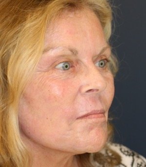 Laser Facial Skin Treatment 201 - after - oblique
