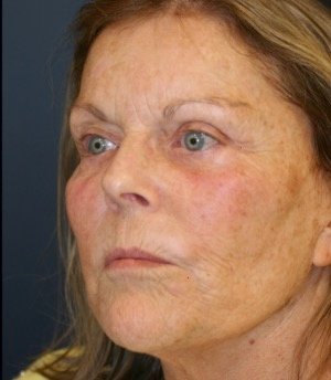 Laser Facial Skin Treatment 201 - before - side