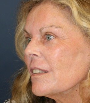 Laser Facial Skin Treatment 201 - after - side