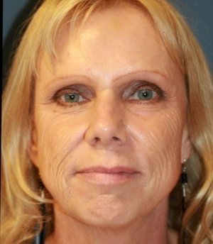 Laser Facial Skin Rejuvenation - before - front
