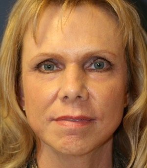 Laser Facial Skin Rejuvenation - after - front