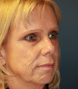 Laser Facial Skin Rejuvenation - before - oblique