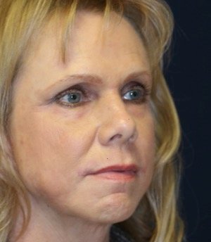 Laser Facial Skin Rejuvenation - after - oblique