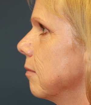 Laser Facial Skin Rejuvenation - before - side