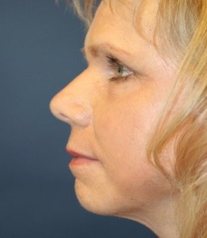 Laser Facial Skin Rejuvenation - after - side