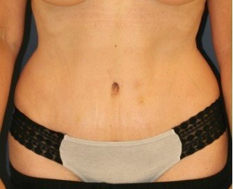 Tummy Tuck 209 - after - front