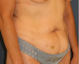 Tummy Tuck 209 - before - oblique