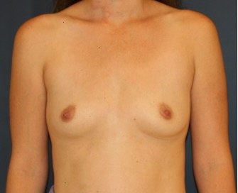 Breast Augmentation 135 - before - front