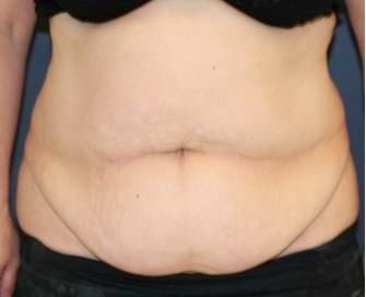 Tummy Tuck 210 - before - front