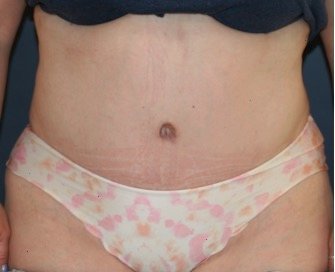 Tummy Tuck 210 - after - front