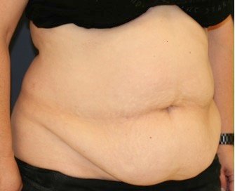 Tummy Tuck 210 - before - oblique