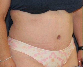 Tummy Tuck 210 - after - oblique