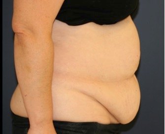 Tummy Tuck 210 - before - side