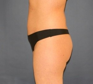 Fat Transfer-BBL 12 - before - front